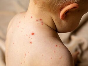 Vacunación contra sarampión, prevención y cuidado de la salud