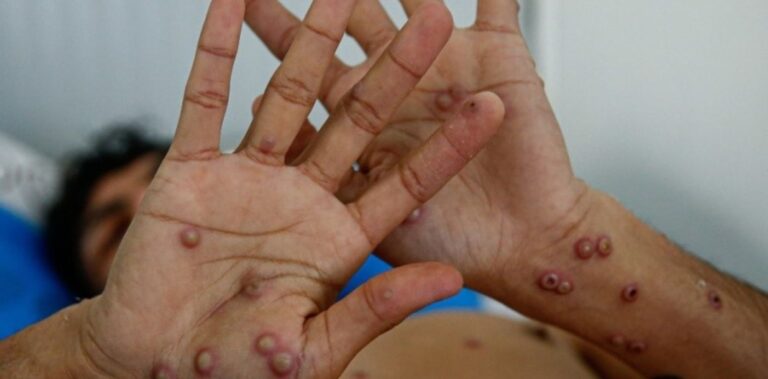 Primer caso en Argentina de la cepa más contagiosa de viruela del mono