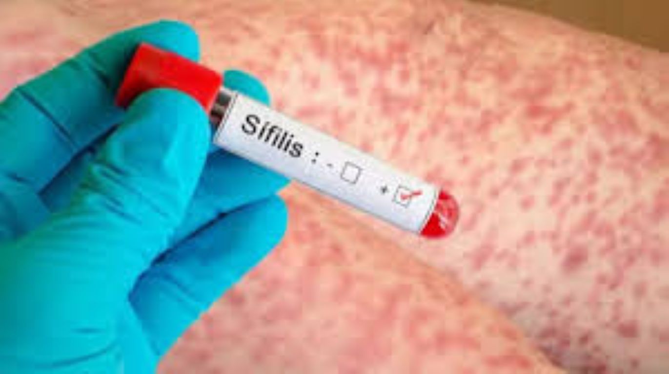 Alarma por la sífilis en Argentina: en 2025 se registró la cifra más alta de la historia y crece el contagio entre adolescentes